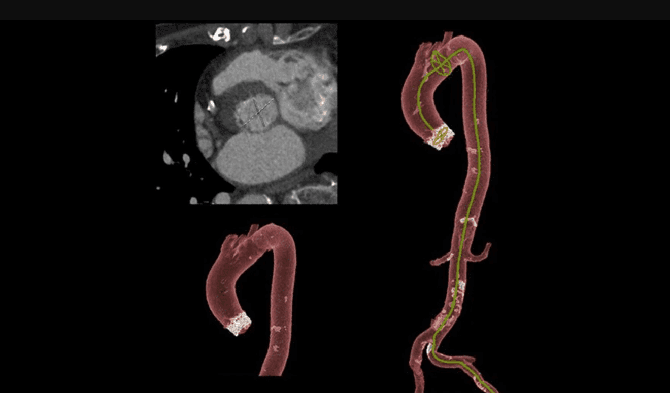 TAVI follow-up whole aorta CT scan taken during a transcatheter aortic valve replacement (TAVR) procedure using a GE Revolution HD unit.