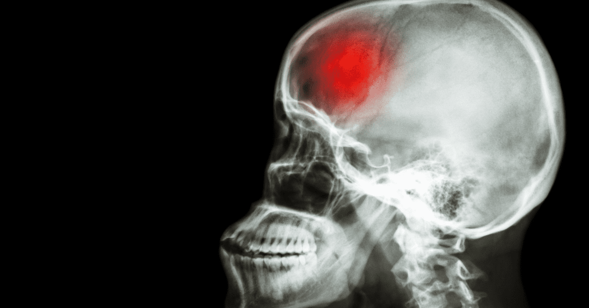 From UC Health: New Mobile Units to Deliver Clot-Busting Drugs to Stroke Patients | blog article by Catalina Imaging
