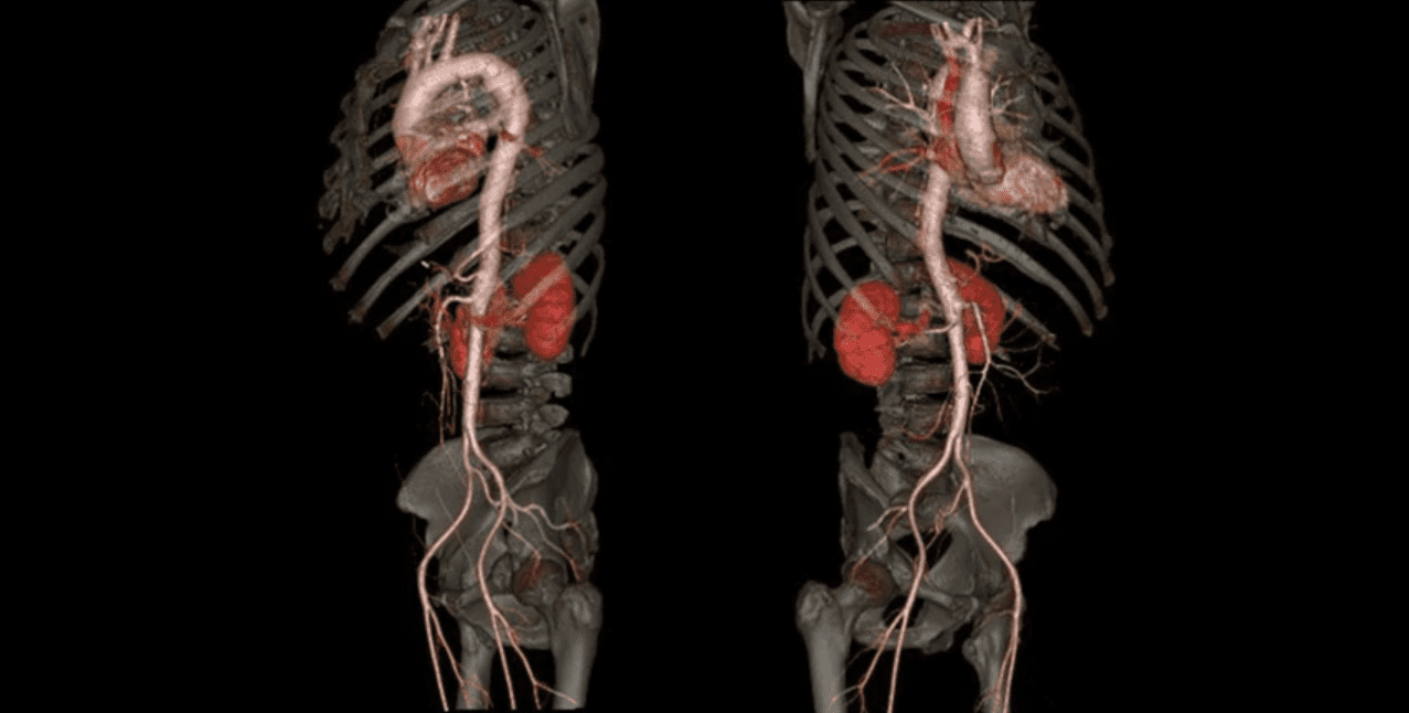 whole aorta CT scan taken during a transcatheter aortic valve replacement (TAVR) procedure using a GE Revolution HD unit.