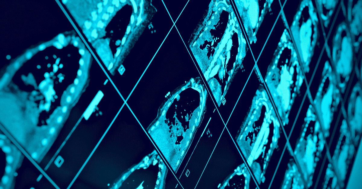 Canon Medical’s Advancements with AI-based Image Reconstruction Technology by Catalina Imaging