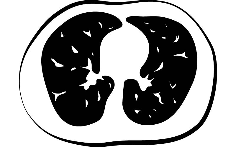 CT scan of healthy lungs