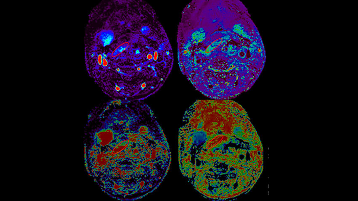 Predicting Free Flap Failure Using CT and MRI Scan